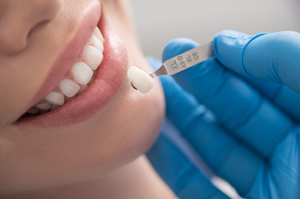 Bọc răng sứ có đau không? Giữ…
