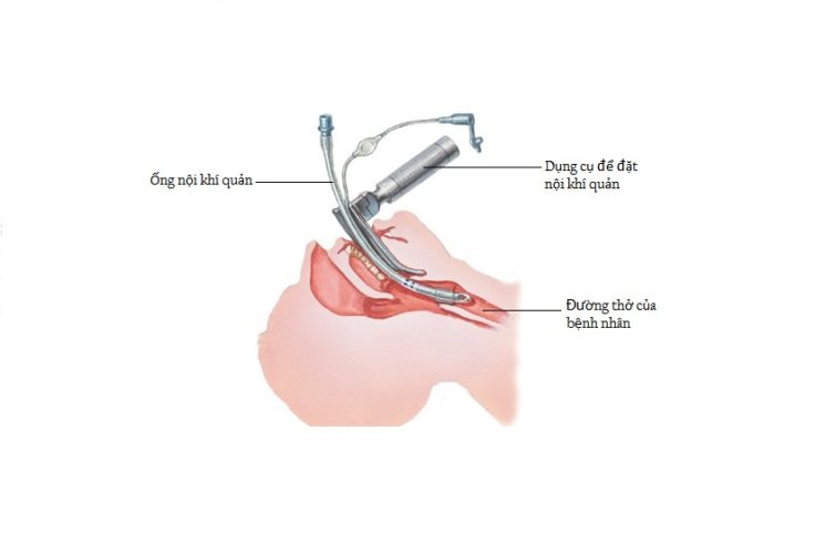 Hình Ảnh Đặt Ống Nội Khí Quản