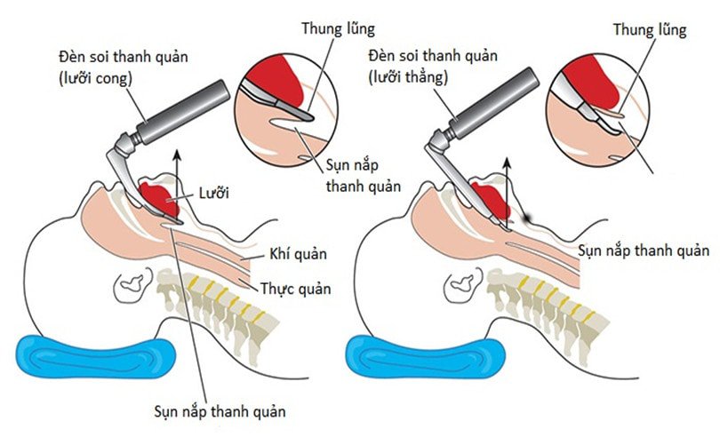 Hình Ảnh Đặt Ống Nội Khí Quản