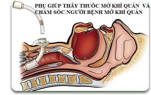 Hình Ảnh Đặt Ống Nội Khí Quản